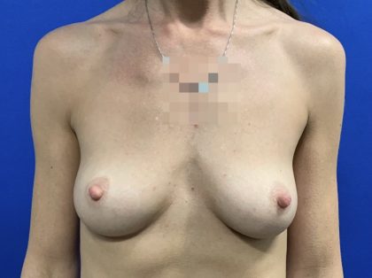 Breast Reconstruction with Direct to Implant with Silicone Implants Before & After Patient #2700