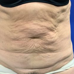 Tummy Tuck Before & After Patient #2549