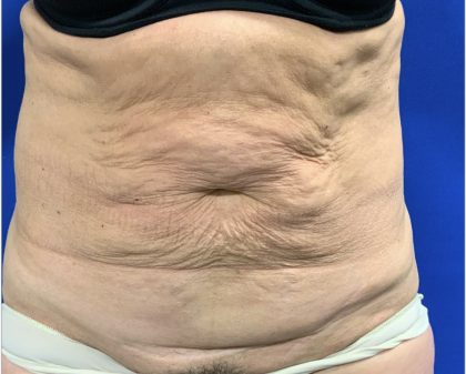 Tummy Tuck Before & After Patient #2549