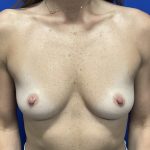 Breast Reconstruction with Direct to Implant with Silicone Implants Before & After Patient #2702