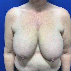 Breast Reduction With Galaflex Before & After Patient #2729