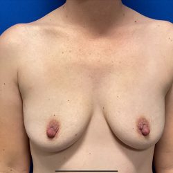 Breast Augmentation Before & After Patient #2635
