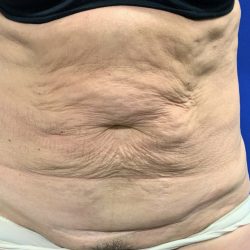 Tummy Tuck Before & After Patient #2547