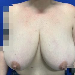 Breast Reduction With Galaflex Before & After Patient #2736