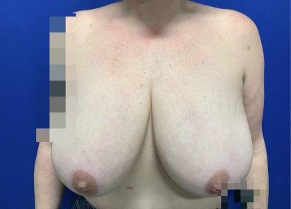 Breast Reduction With Galaflex Before & After Patient #2736