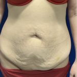 Tummy Tuck Before & After Patient #2550