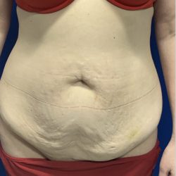 Tummy Tuck Before & After Patient #2550