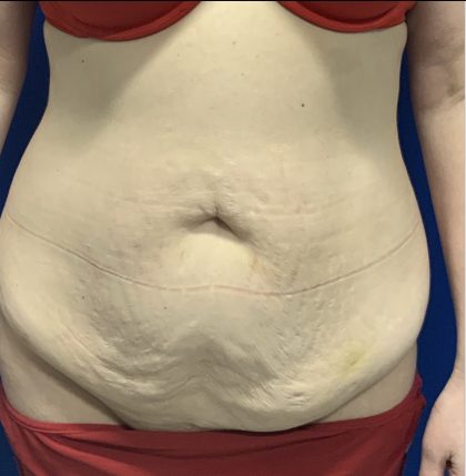 Tummy Tuck Before & After Patient #2550
