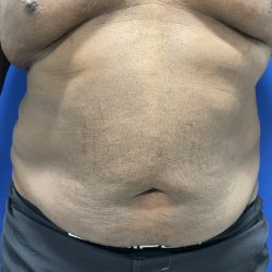 Emsculpt Neo Before & After Patient #2793