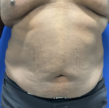 Emsculpt Neo Before & After Patient #2793