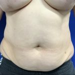 Wellness Program Before & After Patient #2800