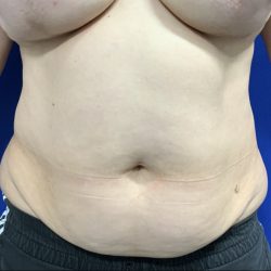 Wellness Program Before & After Patient #2800