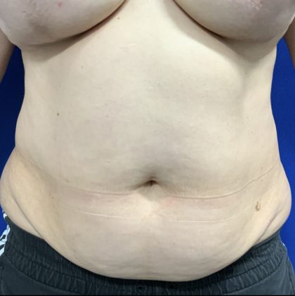 Wellness Program Before & After Patient #2800