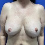 Implant Exchange Due to Ruptured Silicone Before & After Patient #2810