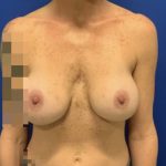 Implant Revision/Removal Before & After Patient #2839