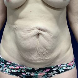 Tummy Tuck Before & After Patient #2551