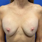 Implant Exchange With Capsulectomy Before & After Patient #2853