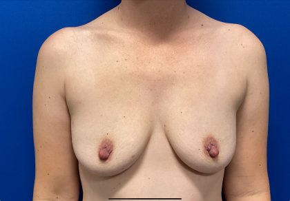 Breast Augmentation Before & After Patient #2635