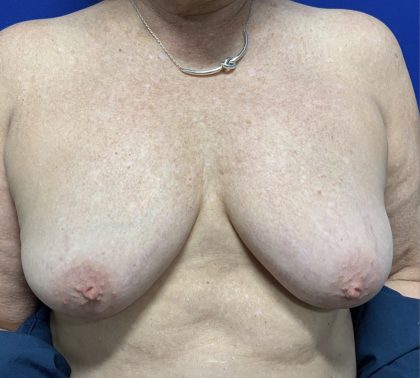 Inverted Nipple Correction with Galaflex Before & After Patient #2875