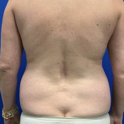 Liposuction Before & After Patient #2887