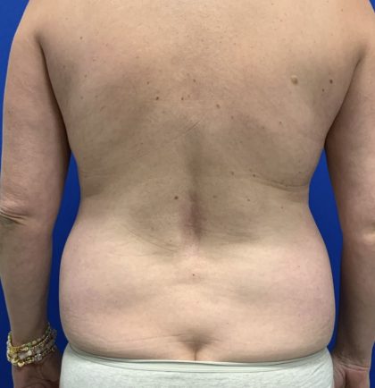 Liposuction Before & After Patient #2887