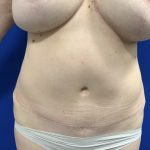 Liposuction Before & After Patient #2888