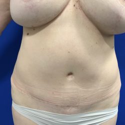 Liposuction Before & After Patient #2888