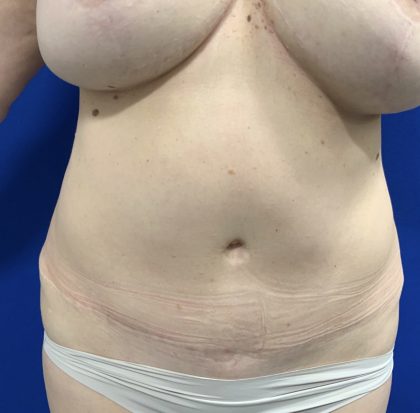 Liposuction Before & After Patient #2888
