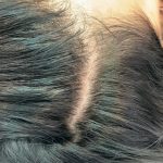PRP For Hair Restoration Before & After Patient #2902