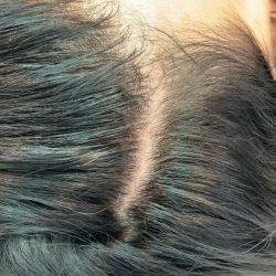 PRP For Hair Restoration Before & After Patient #2902