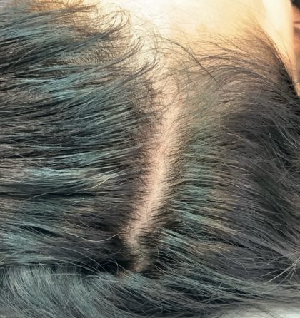 PRP For Hair Restoration Before & After Patient #2902