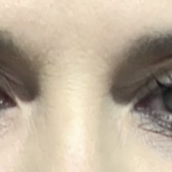 Blepharoplasty Before & After Patient #2586
