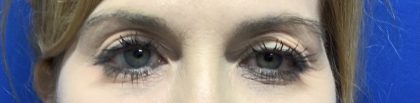 Blepharoplasty Before & After Patient #2586