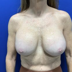 Implant Removal with Capsulectomy Before & After Patient #2910