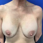 Implant Removal with Capsulectomy Before & After Patient #2915