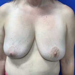 Implant Removal with Capsulectomy Before & After Patient #2916