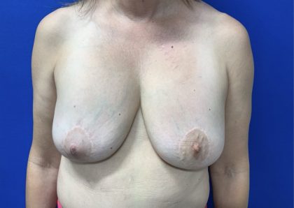 Implant Removal with Capsulectomy Before & After Patient #2916
