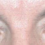 Blepharoplasty Before & After Patient #2587