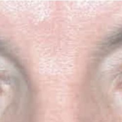 Blepharoplasty Before & After Patient #2587