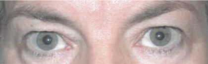 Blepharoplasty Before & After Patient #2587