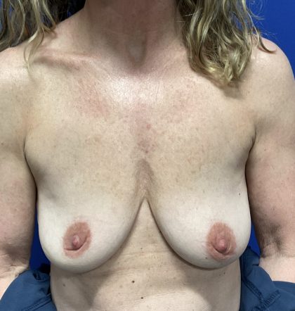 Breast Augmentation Before & After Patient #2629