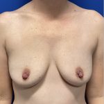 Breast Augmentation Before & After Patient #2630