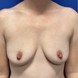 Breast Augmentation Before & After Patient #2630