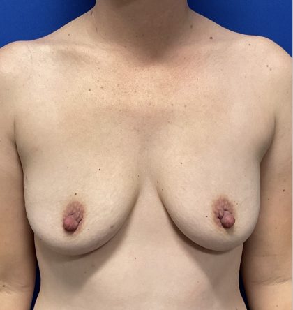 Breast Augmentation Before & After Patient #2630