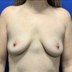Breast Augmentation Before & After Patient #2631