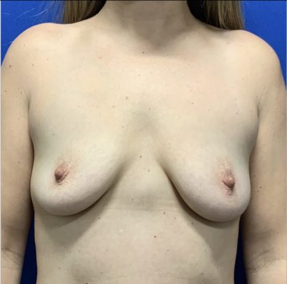 Breast Augmentation Before & After Patient #2631