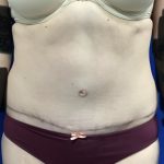 Tummy Tuck Before & After Patient #2548