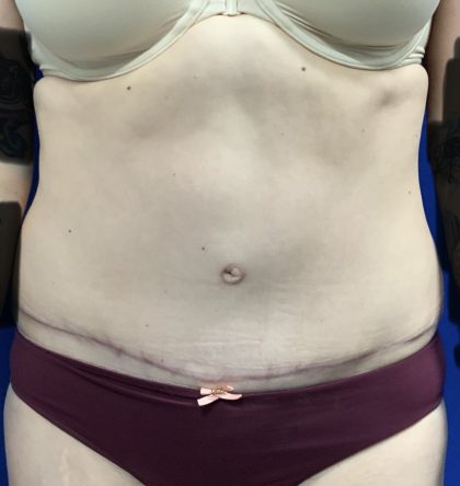 Tummy Tuck Before & After Patient #2548