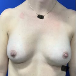Breast Augmentation Before & After Patient #2633