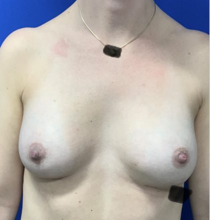 Breast Augmentation Before & After Patient #2633